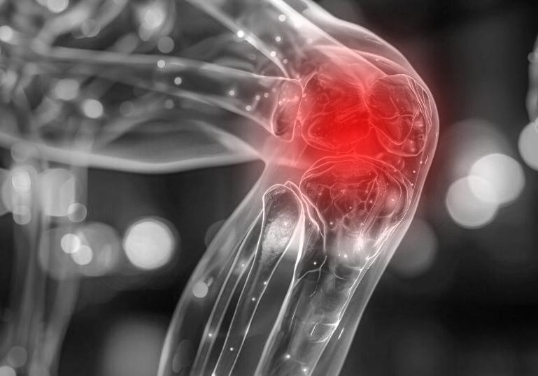 Knee Replacement Procedure