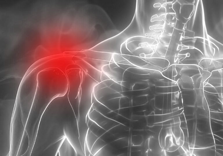 Shoulder Replacement Procedure